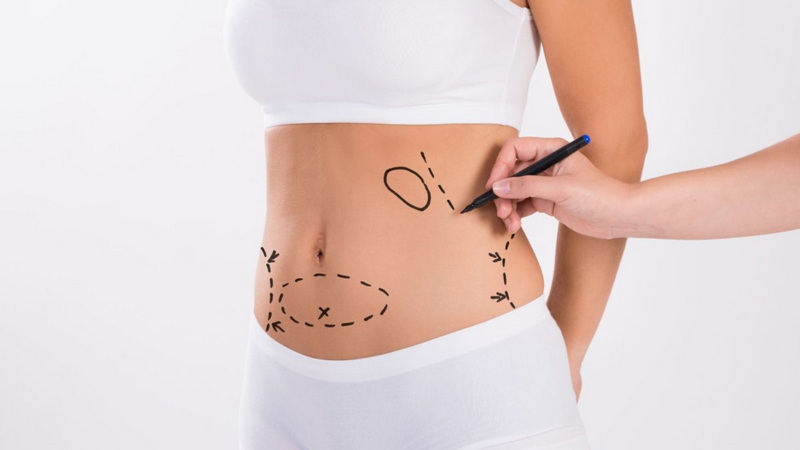 Особенности проведения липосакции живота и этапы восстановления Body-Contouring-Clinic.jpg